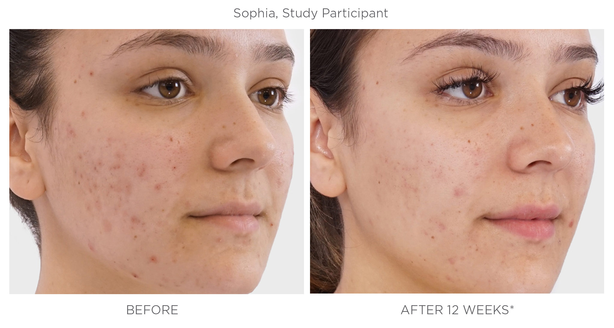 Side by side before and after images of Sophia, Study Participant.