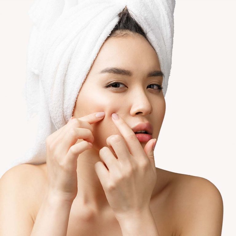Types of Acne, Causes and Effects