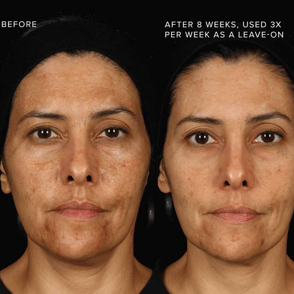 Before and after image of a woman with discoloration, showing effects of Rodan + Fields Multi-Acid Enzyme Peel after 8 weeks, used 3X per week as a leave-on treatment.