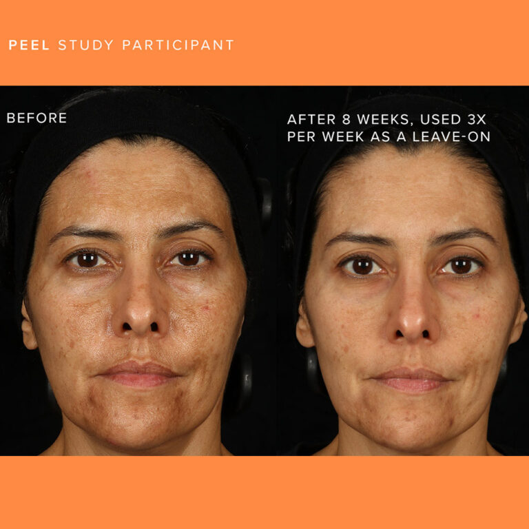 Combat Acne & Discoloration: Top Solutions & Guidance