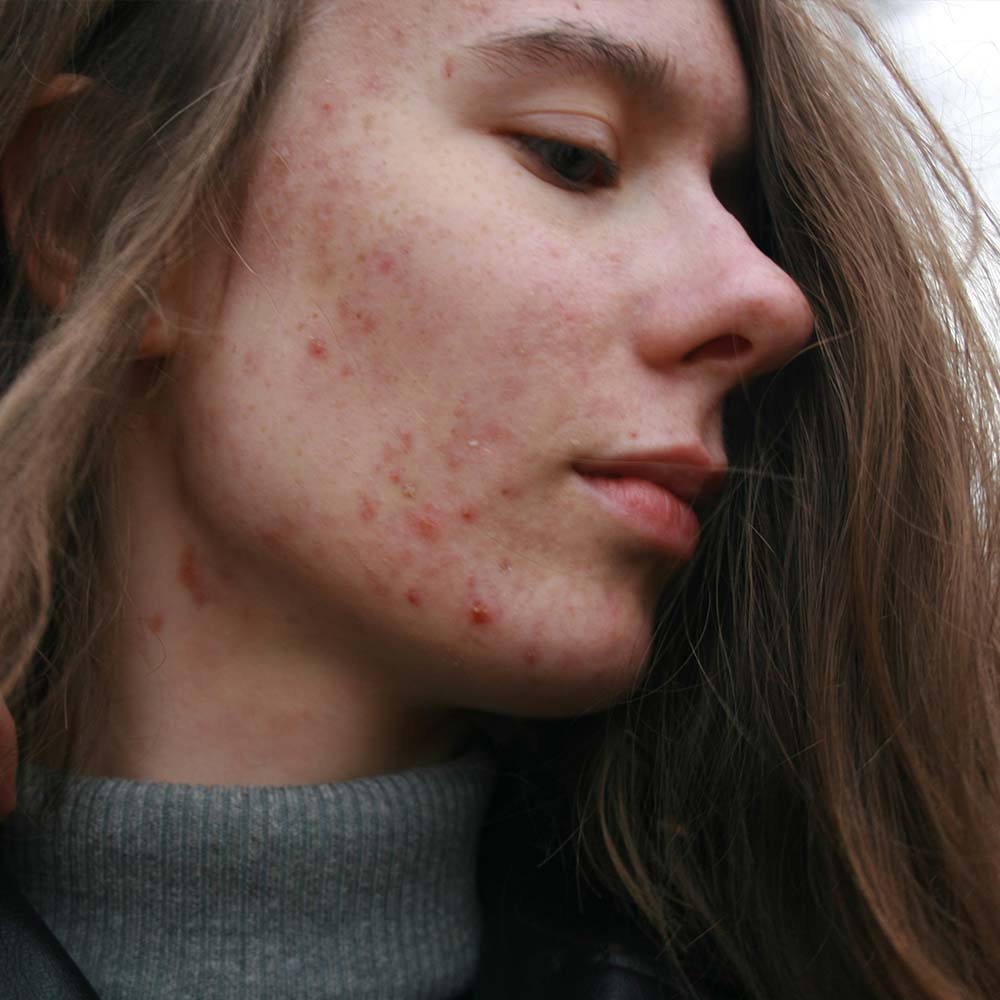 Profile view of young person with acne. Photo by Barbara Krysztofiak