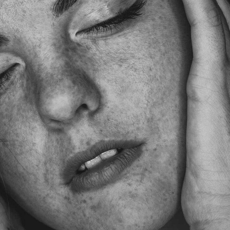 Closeup of young woman with some skin discoloration. Photo by Valerie Elash.