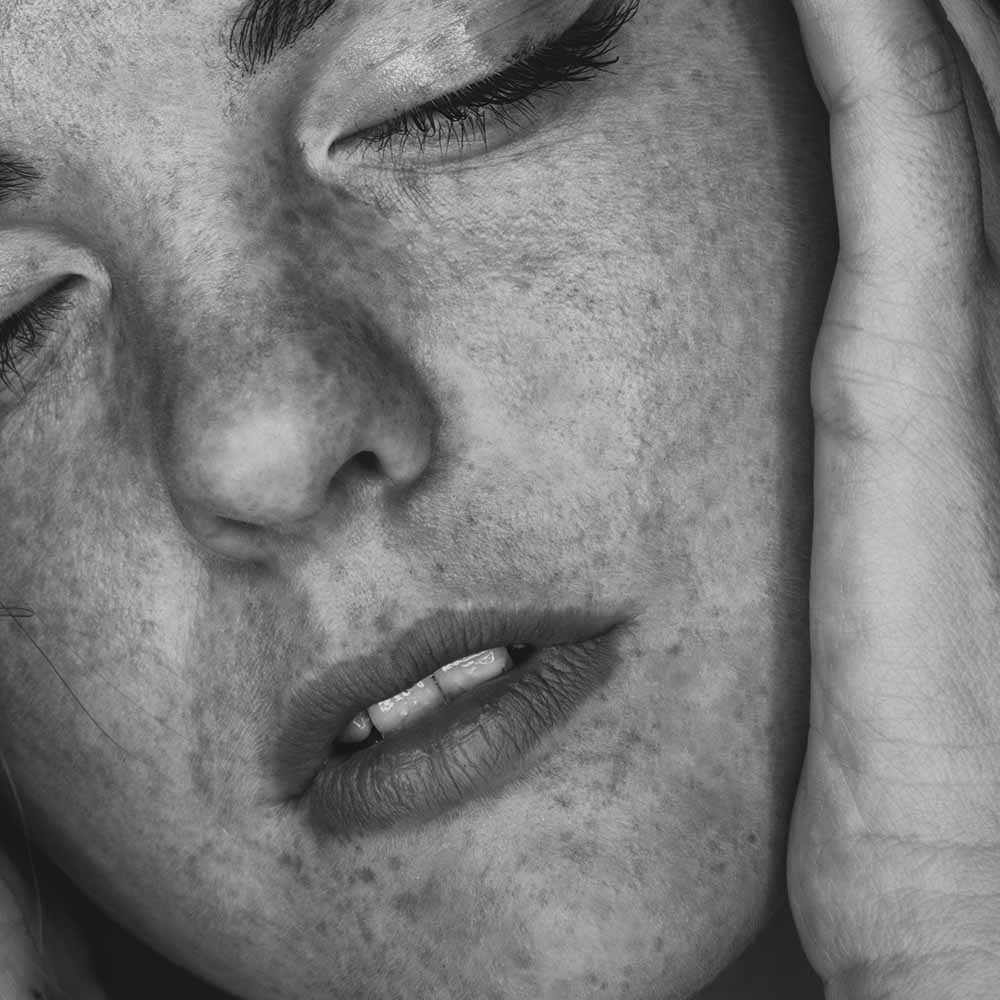 Closeup of young woman with some skin discoloration. Photo by Valerie Elash.