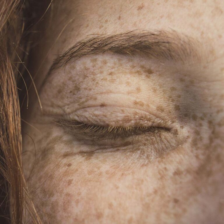 Vitamin C for Dark Spots & Hyperpigmentation