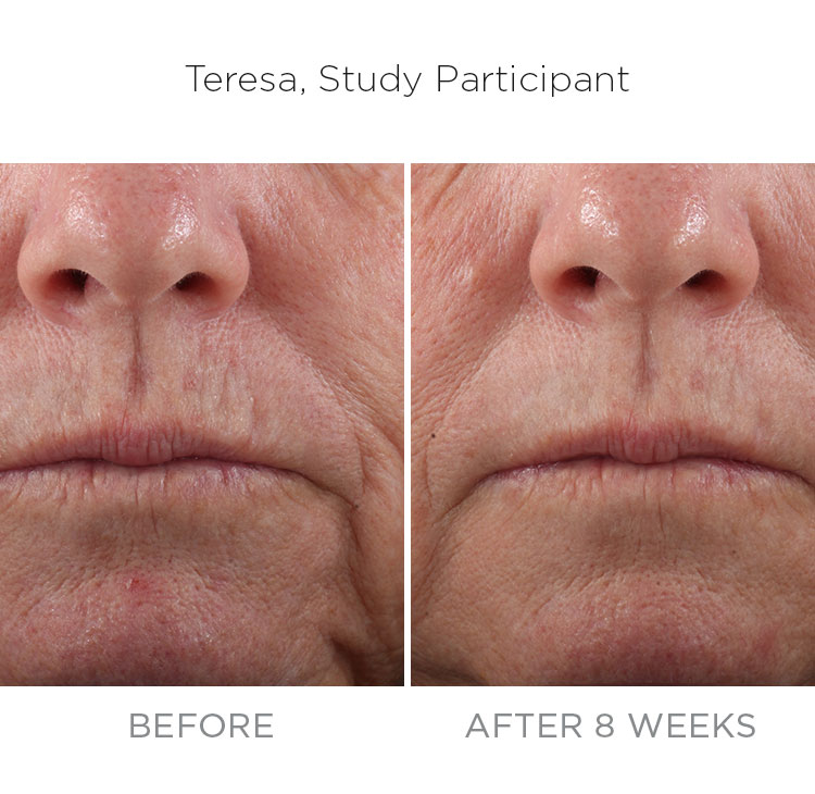 Fine Line Rommops Difference Between Fine Lines And Wrinkles