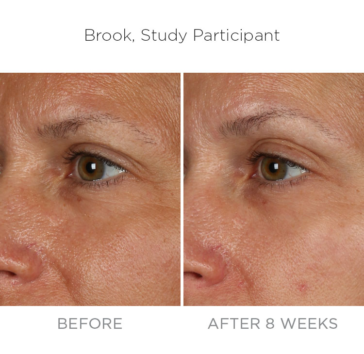 Fine Line Rommops Difference Between Fine Lines And Wrinkles