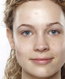 Acne Mouth